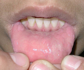 lesion de papiloma en boca