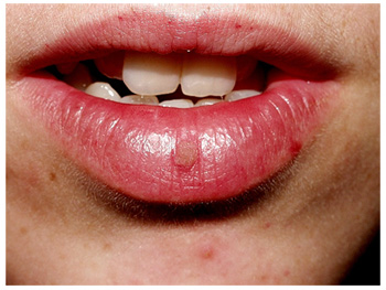 papiloma en los labios de la boca imagini de curățare a colonului de paraziți