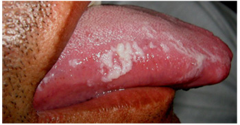 urinary bladder papilloma histology medicamente de helmint pentru adulți