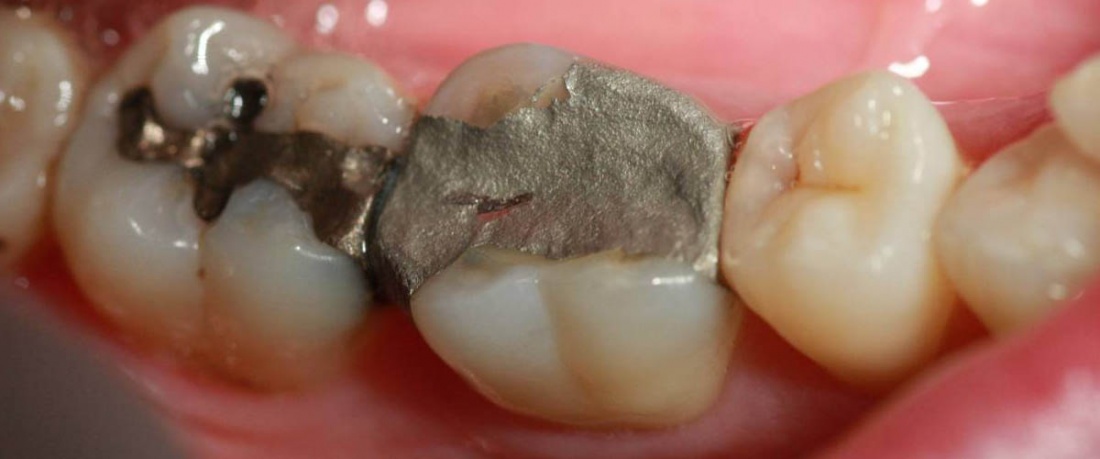 restauraciones dentales